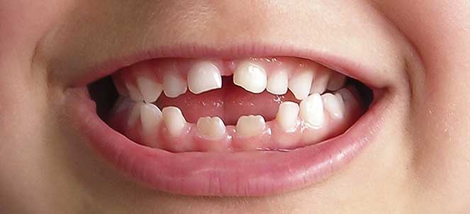 Mordida Cruzada Posterior - Francisco Stroparo Ortodontia