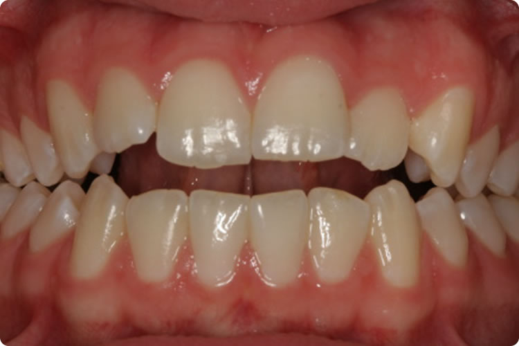 Análise das Bases Ósseas no Sentido Transversal - Francisco Stroparo Ortodontia
