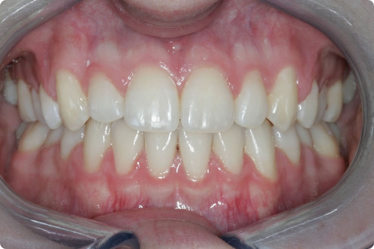 Análise dos Dentes no Sentido Vertical - Francisco Stroparo Ortodontia