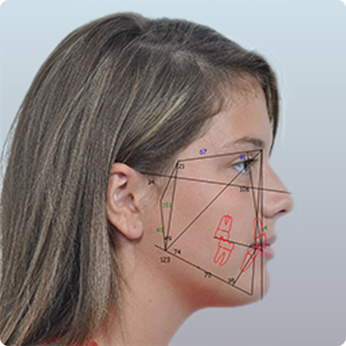 Análise Facial Anteroposterior - Francisco Stroparo Ortodontia