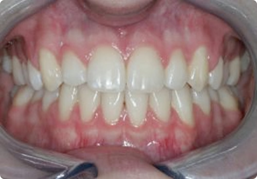 Análise Transversal dos dentes - Francisco Stroparo Ortodontia