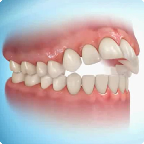Análise vertical dos dentes - Francisco Stroparo Ortodontia
