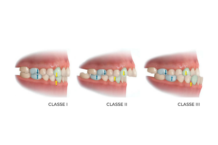 Análise dos Dentes no Sentido Anteroposterior