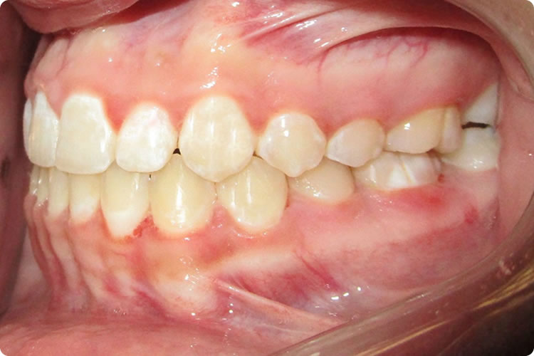 Ortodontia Corretiva - Classe 1 - Francisco Stroparo Ortodontia