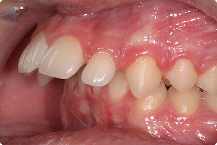 Ortodontia Corretiva - Classe 2 - Francisco Stroparo Ortodontia