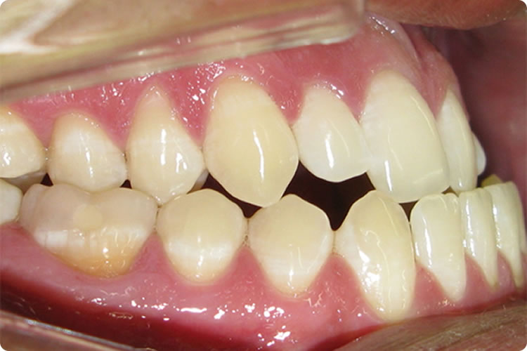 Ortodontia Corretiva - Classe 3 - Francisco Stroparo Ortodontia