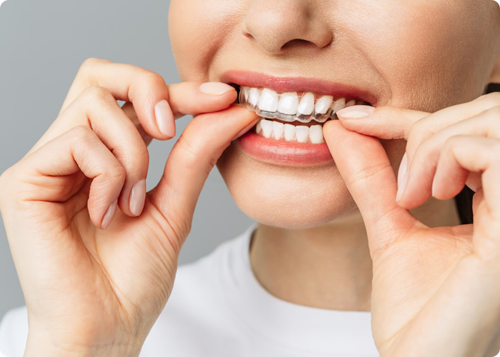 A Invisalign® arrumou briga no Brasil – Como funciona a Invisalign® para o  dentista/ortodontista americano? – Revalida USA