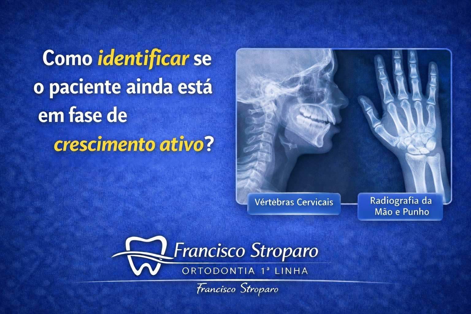 Avaliação da idade óssea com radiografia de mão e punho e vértebras cervicais em ortodontia