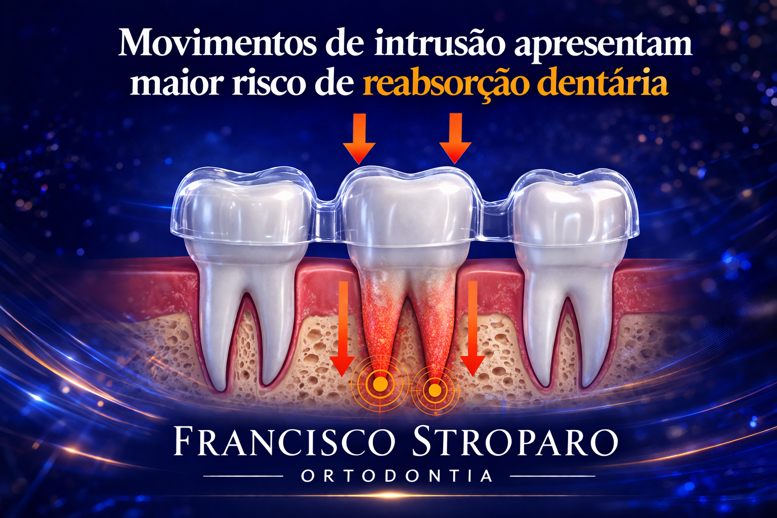 na imagem 3 molares inferiores recebendo movimento de intrução O 1º molar está representando uma força imposta pelo alinhador, as raizes estão vermelhas para representaar a força ortodôntica marca d agua Francisco Stroparo Ortodontia na base da imagem