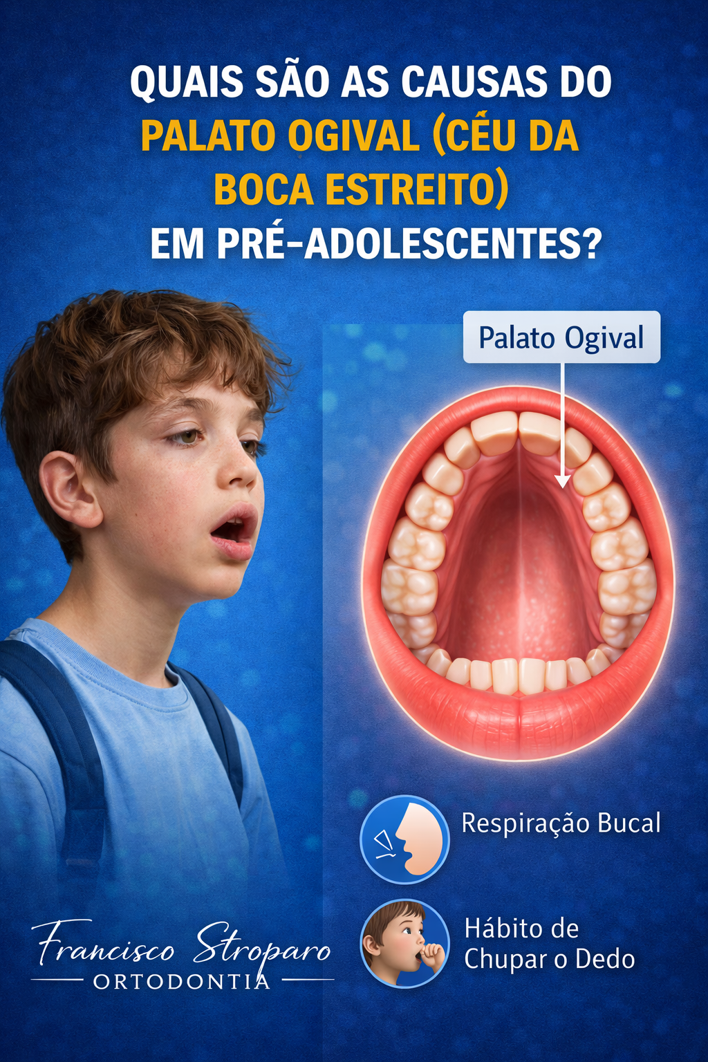 Causas do palato ogival em pré-adolescentes com respiração bucal e hábito de chupar o dedo