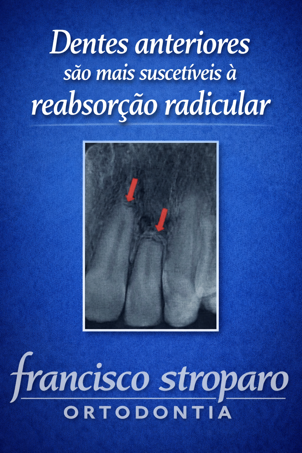 imagem radiografica mostrando 2 reabsorções radiculares nos incisivos superiorestitulo :dentes anteriores são mais propensos a reabsorção radicular 
marca d agua Francisco Stroparo Ortodontia