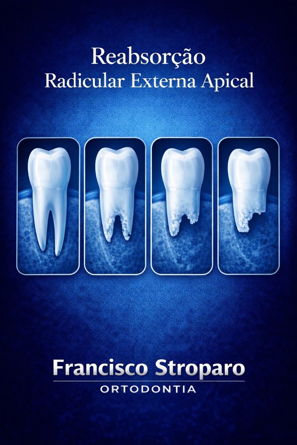 imagem com quatro molares em sequencia demonstrando a evolução da reabsorção dentária