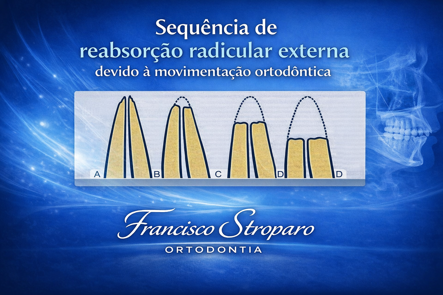 a imagem demonstra a seqquencia de rreabsorção externa em invisivos superiores o primeiro dente sem reabosção, seguindo de aumento do problema até chegar na reabsorção de meia raiz