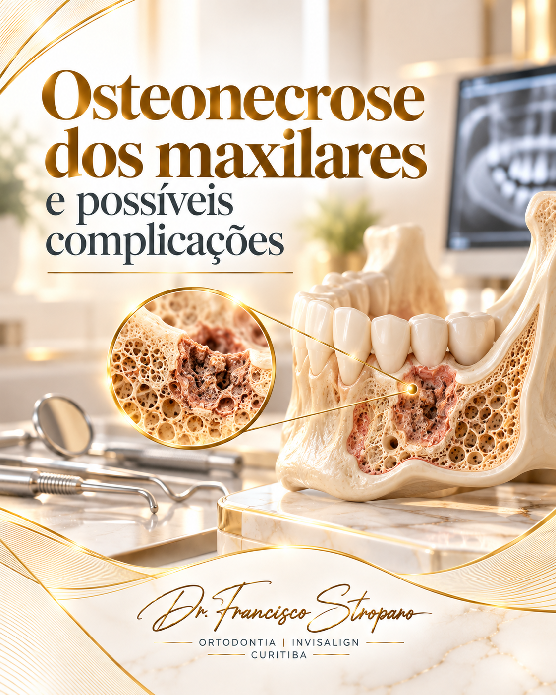 Osteonecrose dos maxilares e possíveis complicações